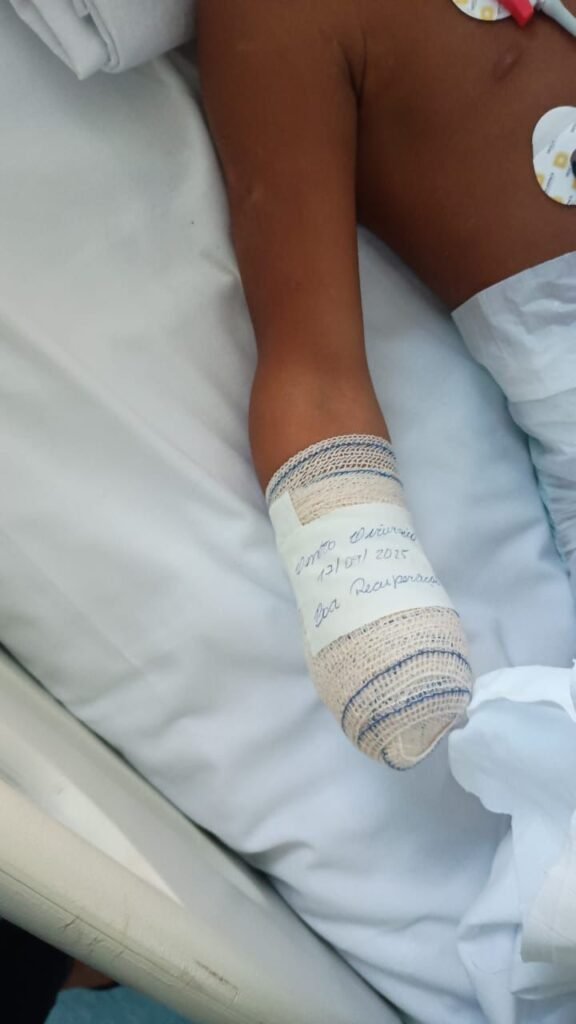 Menino de 8 Anos Perde A Mão e Dedos do Pé Após Explosão em Costa Barros