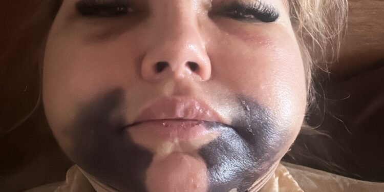 Advogada tem rosto deformado após procedimento estético; dentista é ré