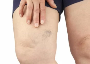 Sofre com varizes? Conheça mitos e verdades sobre a doença