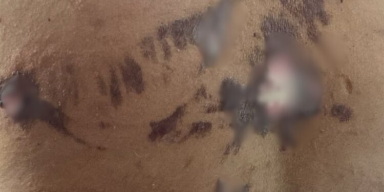 Paciente diz ter ficado sem apoio da prefeitura após queimaduras