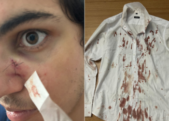 Turista diz que hemorragia teve e levou pontos no nariz após ser agredido durante assalto no Festival Virada Salvador: ‘Pesadelo’