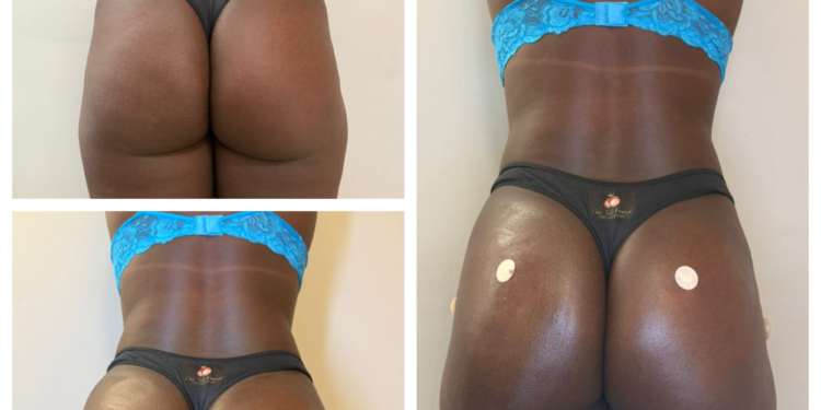 Harmonização de glúteo vira tendência entre as músicas do carnaval carioca