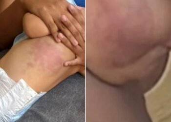 Bebê de 1 ano foi torturado em Arraial do Cabo por 15 dias, diz laudo; mãe e padrasto presos alegaram ataque de pitbull