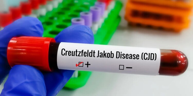Doença de Creutzfeldt-Jakob: Entenda a Condição Rara e a Busca Global por Tratamentos Doença de Creutzfeldt-Jakob: Entenda a Condição Rara e a Busca Global por Tratamentos