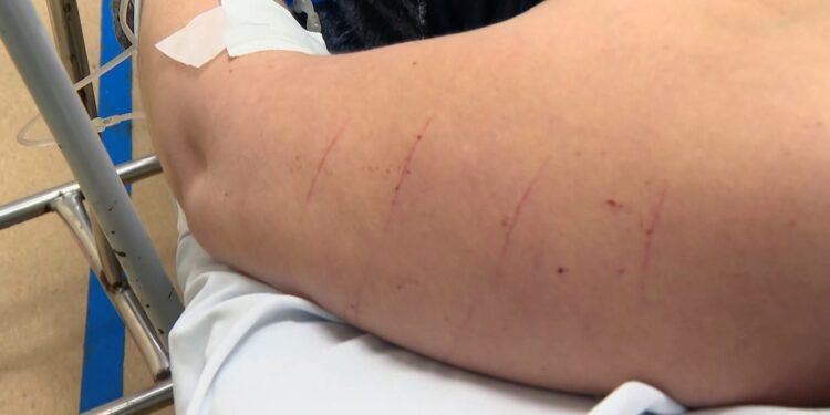 Mulher relata ter sido atacada com tesoura durante assalto em São Gonçalo; um dos golpes foi na barriga Mulher relata ter sido atacada com tesoura durante assalto em São Gonçalo; um dos golpes foi na barriga