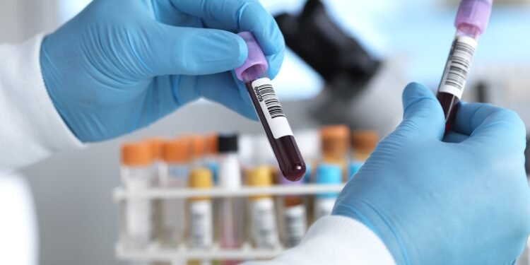 Exame de sangue para auxiliar no diagnóstico de Alzheimer chega ao Brasil Exame de sangue para auxiliar no diagnóstico de Alzheimer chega ao Brasil