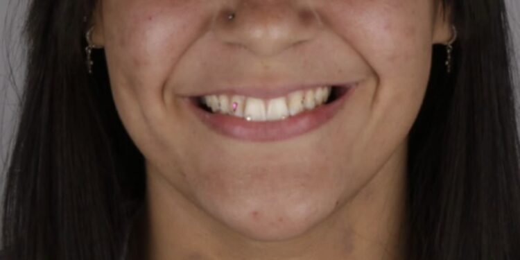 Jovem dá golpe após colocar cristais nos dentes e é presa ao ser reconhecida por dentista em parque, diz profissional