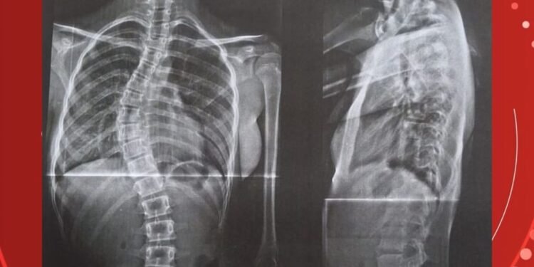 Após enfrentar o governo, mãe consegue cirurgia para filha com coluna em formato de ‘S’ em RO
