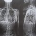 Após enfrentar o governo, mãe consegue cirurgia para filha com coluna em formato de ‘S’ em RO