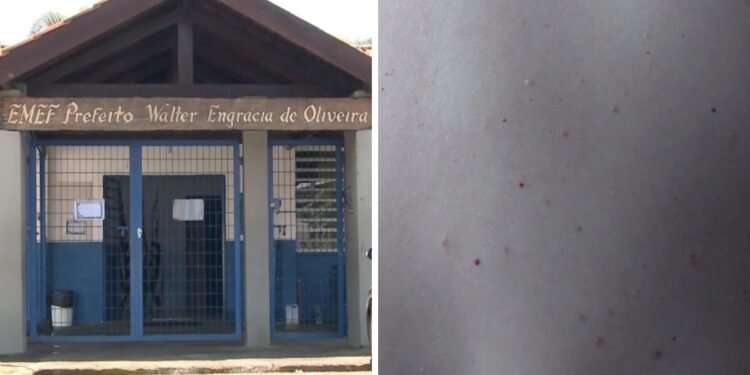 Sobe para 71 o número de alunos e funcionários afastados por suspeita de sarna em escola de Atibaia Sobe para 71 o número de alunos e funcionários afastados por suspeita de sarna em escola de Atibaia
