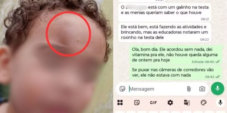 Mãe denuncia creche após menino de 2 anos aparecer com hematoma no rosto no litoral de SP